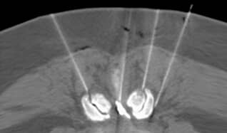 CT-gesteuerte epidurale Umflutung