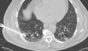 Echtbild einer CT-gesteuerte Biopsie