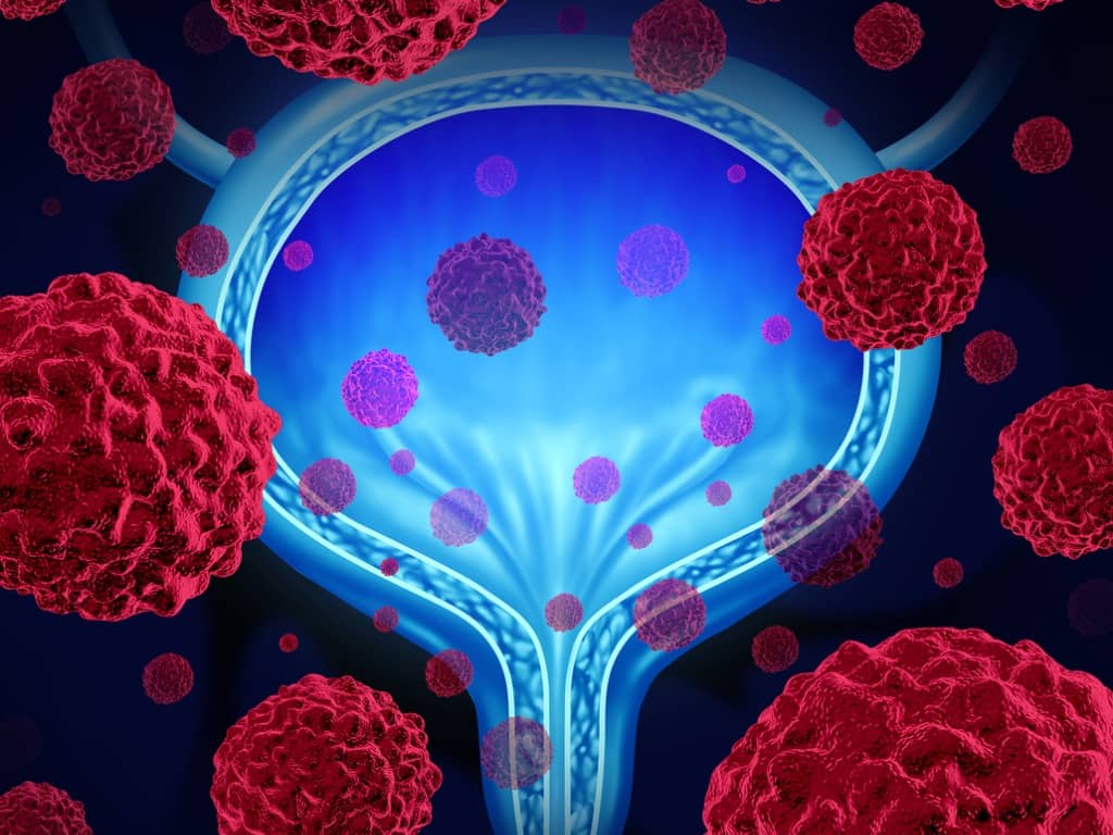 OrgandarstellungHarnblase mit Krebszellen im Vordergrund
