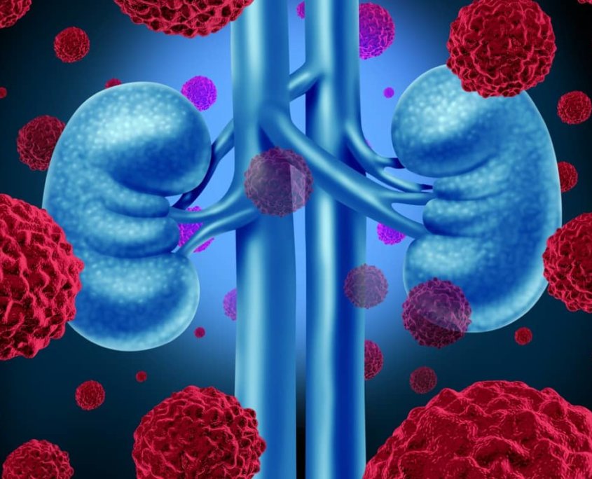Organdarstellung Nierenkrebs mit Krebszellen im Vordergrund