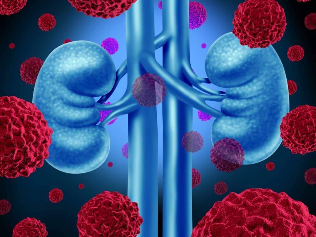 Organdarstellung Nierenkrebs mit Krebszellen im Vordergrund