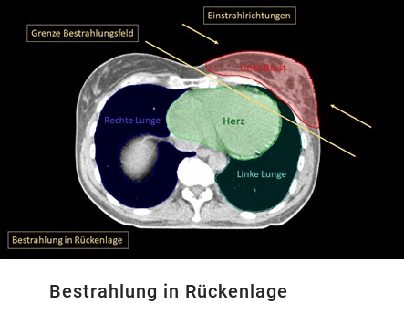 Bestrahlung in Rückenlage bei Brustkrebs - Schnittbilddarstellung