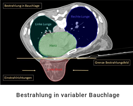 Bestrahlung in Bauchlage bei Brustkrebs - Schnittbilddarstellung
