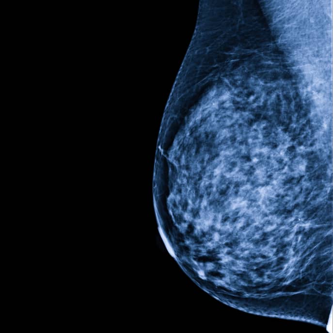 Digitales Röntgenbild bei einer Mammographie - Brustdiagnostik
