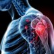 Eine Röntgenansicht eines Schultergelenks mit Arthrose