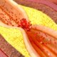 Ansicht einer verkalkten Arterie mit sich stauenden Blutplättchen