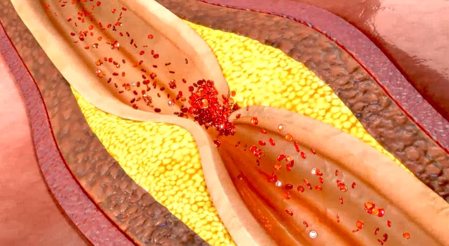 verengte arterie Ansicht einer verkalkten Arterie mit sich stauenden Blutplättchen